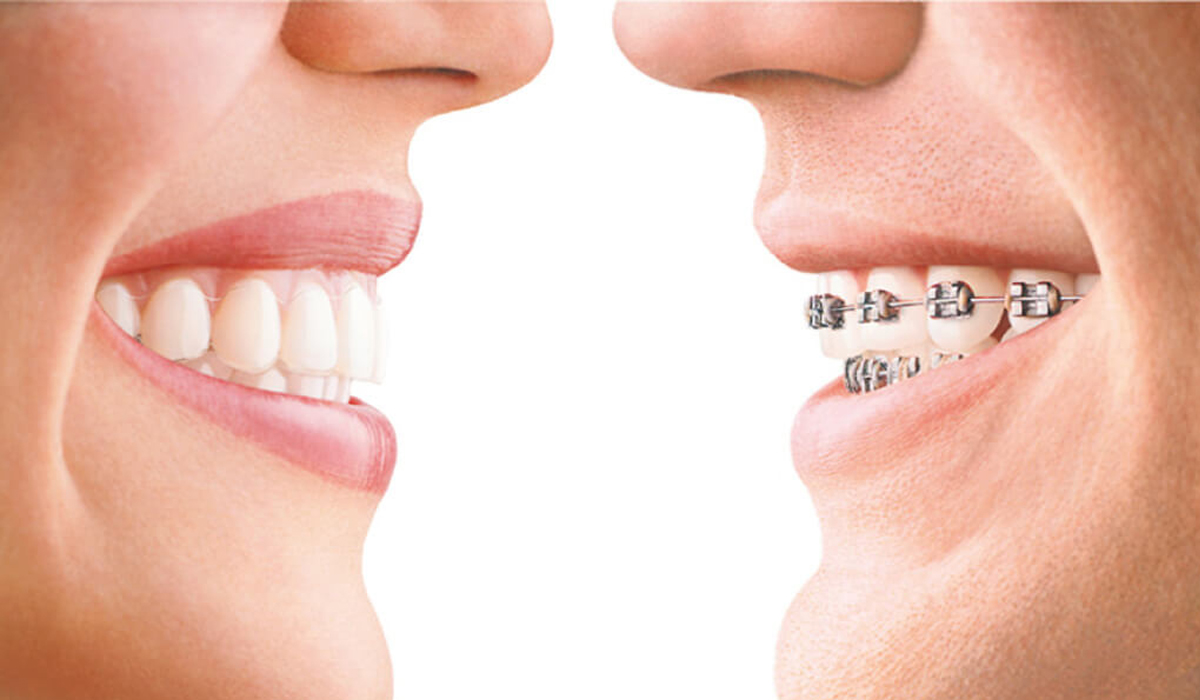Comparison of Braces and Invisalign Aligners Orthodontic Treatments